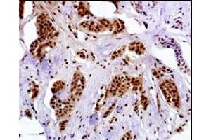 Immunostaining of paraformldehyde-fixed and paraffin-embedded hun breast carcino with GE-A4 antibody Cat (ABIN390108 and ABIN2840620) (1:50 dilution), followed by reacting with biotin-conjugated secondary antibody, ABC solution and developing with DAB. (MAGEA4 antibody  (N-Term))