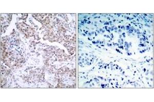 Immunohistochemistry (IHC) image for anti-Tumor Protein P53 (TP53) (pSer15) antibody (ABIN2888497) (p53 antibody  (pSer15))