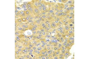 Immunohistochemistry of paraffin-embedded human liver cancer using PA2G4 Antibody. (PA2G4 antibody  (AA 1-394))