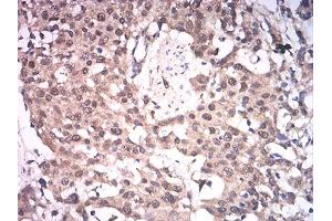 Immunohistochemical analysis of paraffin-embedded esophageal cancer tissues using ASH2L mouse mAb with DAB staining. (ASH2L antibody  (AA 493-628))