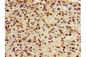 Immunohistochemistry of paraffin-embedded human glioma using ABIN7153030 at dilution of 1:100 (FOXD3 antibody  (AA 1-140))