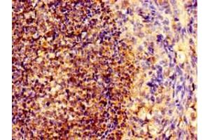 Immunohistochemistry of paraffin-embedded human ovarian cancer using ABIN7161294 at dilution of 1:100 (Notch1 antibody  (AA 2428-2555))