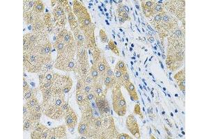 Immunohistochemistry of paraffin-embedded Human liver cancer using ALG2 Polyclonal Antibody at dilution of 1:100 (40x lens). (ALG2 antibody)