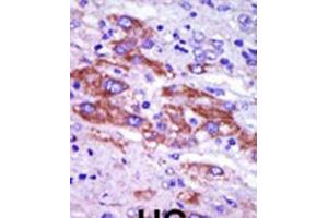 Formalin-fixed and paraffin-embedded human cancer tissue reacted with the primary antibody, which was peroxidase-conjugated to the secondary antibody, followed by DAB staining. (Casein Kinase 1 delta antibody  (C-Term))