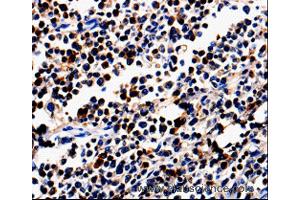 Immunohistochemistry of Human colon cancer using ALOX5 Polyclonal Antibody at dilution of 1:50 (ALOX5 antibody)