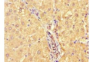 Immunohistochemistry of paraffin-embedded human liver cancer using ABIN7143724 at dilution of 1:100 (Allergin-1 antibody  (AA 249-343))
