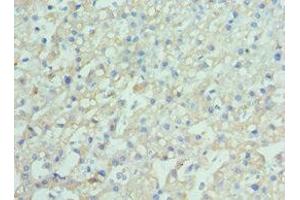 Immunohistochemistry of paraffin-embedded human liver cancer using ABIN7151389 at dilution of 1:100 (ENPP2 antibody  (AA 564-863))