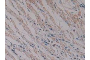 IHC-P analysis of Human Stomach Cancer Tissue, with DAB staining. (PKIB antibody  (AA 8-76))