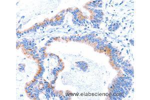 Immunohistochemistry of Human lung cancer using SMG8 Polyclonal Antibody at dilution of 1:50 (SMG8 antibody)