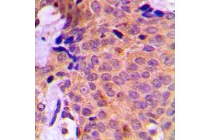 Immunohistochemical analysis of UBA2 staining in human breast cancer formalin fixed paraffin embedded tissue section. (UBA2 antibody  (C-Term))