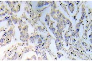 Immunohistochemistry (IHC) analyzes of IRS-1 antibody in paraffin-embedded human breast carcinoma tissue. (IRS1 antibody)