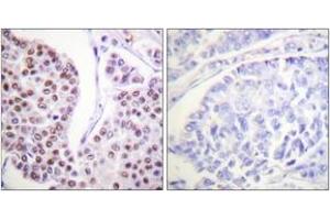 Immunohistochemistry analysis of paraffin-embedded human breast carcinoma tissue, using Histone H4 (Ab-8) Antibody. (Histone H4 antibody  (AA 6-55))