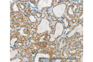 Immunohistochemistry of Human cervical cancer using AANAT Polyclonal Antibody at dilution of 1:40 (AANAT antibody)