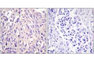Immunohistochemistry analysis of paraffin-embedded human breast carcinoma tissue, using UBE1L Antibody. (UBA7 antibody  (AA 963-1012))