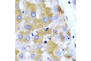 Immunohistochemical analysis of GNT1 staining in human liver cancer formalin fixed paraffin embedded tissue section. (Ugt1 antibody)