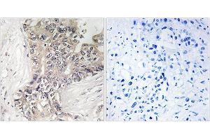 Immunohistochemistry analysis of paraffin-embedded human liver carcinoma tissue using B3GALTL antibody. (B3GALTL antibody)