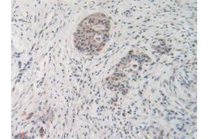 IHC-P analysis of Human Pancreas Cancer Tissue, with DAB staining. (MMP19 antibody  (AA 98-508))