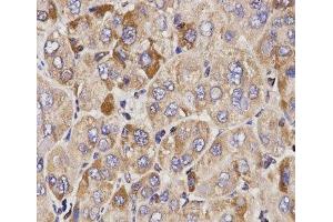 Immunohistochemistry of paraffin-embedded Human liver cancer using GAS2 Polyclonal Antibody at dilution of 1:200 (40x lens). (GAS2 antibody)