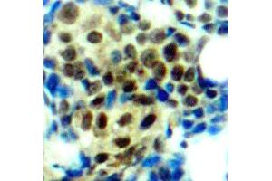 Immunohistochemistry of paraffin-embedded human breast carcinoma tissue, using Phospho-MAPK3-T202 antibody (ABIN2987683). (ERK1 antibody  (pThr202))