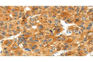 Immunohistochemistry of paraffin-embedded Human liver cancer tissue using STXBP4 Polyclonal Antibody at dilution 1:40 (STXBP4 antibody)