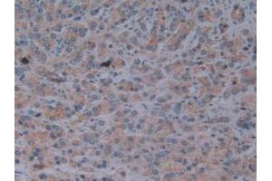 IHC-P analysis of Human Prostate Gland Cancer Tissue, with DAB staining. (Fibrillin 1 antibody  (AA 246-389))