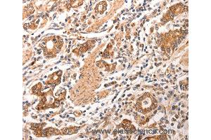 Immunohistochemistry of Human gastric cancer using CCL17 Polyclonal Antibody at dilution of 1:70 (CCL17 antibody)
