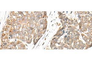 Immunohistochemistry of paraffin-embedded Human thyroid cancer tissue using COA7 Polyclonal Antibody at dilution of 1:55(x200) (C1orf163 antibody)