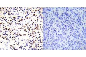 Immunohistochemical analysis of paraffin-embedded human malignant lymphoma tissue using Histone H3. (Histone H3.1 antibody  (pThr3))