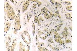 Immunohistochemistry (IHC) analyzes of GATA-1 antibody in paraffin-embedded human breast carcinoma tissue. (GATA1 antibody)