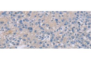 Immunohistochemistry of paraffin-embedded Human liver cancer tissue using CREBZF Polyclonal Antibody at dilution of 1:50(x200) (CREBZF antibody)