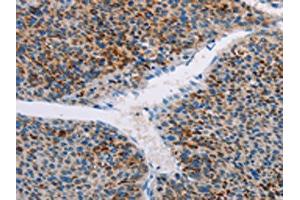 The image on the left is immunohistochemistry of paraffin-embedded Human liver cancer tissue using ABIN7128388(AMOTL2 Antibody) at dilution 1/20, on the right is treated with fusion protein. (AMOTL2 antibody)