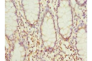 Immunohistochemistry of paraffin-embedded human colon cancer using ABIN7156012 at dilution of 1:100 (HSDL2 antibody  (AA 1-345))