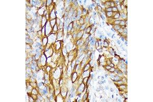 Immunohistochemistry of paraffin-embedded human esophageal cancer using Cytokeratin 6 (KRT6) (KRT6) Rabbit mAb (ABIN1680165, ABIN3019111, ABIN3019112 and ABIN7101717) at dilution of 1:100 (40x lens). (KRT6A antibody)