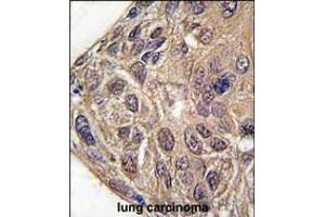 Formalin-fixed and paraffin-embedded human lung carcinoma tissue reacted with YARS antibody , which was peroxidase-conjugated to the secondary antibody, followed by DAB staining. (YARS antibody  (C-Term))