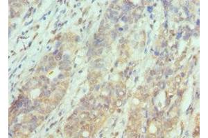 Immunohistochemistry of paraffin-embedded human endometrial cancer using ABIN7169126 at dilution of 1:100 (PAK1 antibody  (AA 1-240))