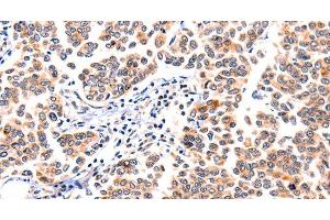 Immunohistochemistry of paraffin-embedded Human breast cancer using GNRHR Polyclonal Antibody at dilution of 1:117 (GNRHR antibody)