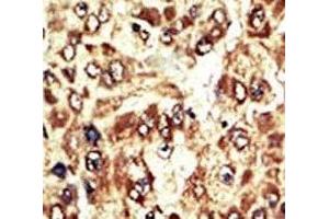 IHC analysis of FFPE human hepatocarcinoma tissue stained with the WEE1 antibody (WEE1 antibody  (AA 604-634))