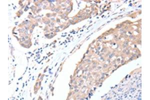 The image on the left is immunohistochemistry of paraffin-embedded Human breast cancer tissue using ABIN7128194(ACTL8 Antibody) at dilution 1/15, on the right is treated with fusion protein. (Actin-Like 8 antibody)