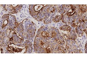 Human adenocarcinoma of endometrium: immunohistochemical staining on CA125. (MUC16 antibody)