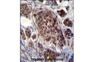 FRAT2 Antibody immunohistochemistry analysis in formalin fixed and paraffin embedded human bladder carcinoma followed by peroxidase conjugation of the secondary antibody and DAB staining. (FRAT2 antibody  (C-Term))