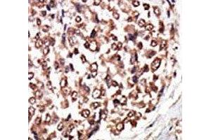 IHC analysis of FFPE human hepatocarcinoma tissue stained with the PKC nu antibody (PRKD3 antibody  (AA 860-890))