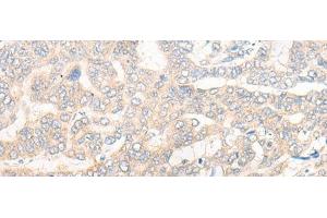 Immunohistochemistry of paraffin-embedded Human liver cancer tissue using CYB5R3 Polyclonal Antibody at dilution of 1:50(x200) (CYB5R3 antibody)