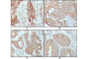 Immunohistochemical analysis of paraffin-embedded human breast carcinoma (A), hepatocarcinoma (B), stomach cancer (C) and colon cancer tissue (D), showing cytoplasmic location with DAB staining using CK18 antibody. (Cytokeratin 18 antibody  (AA 391-483))