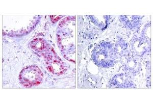 Immunohistochemical analysis of paraffin-embedded human breast carcinoma tissue using c-Jun (phospho-Ser243) antibody (E011025). (C-JUN antibody  (pSer243))