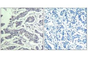 Immunohistochemical analysis of paraffin-embedded human breast carcinoma tissue using AKT1/AKT2/AKT3(Phospho-Tyr315/316/312) Antibody(left) or the same antibody preincubated with blocking peptide(right). (AKT 1/2/3 antibody  (pTyr312, pTyr315, pTyr316))