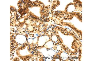 Immunohistochemistry of Human thyroid cancer using SERPINB1 Polyclonal Antibody at dilution of 1:30 (SERPINB1 antibody)