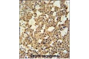 C Antibody (N-term) (ABIN650926 and ABIN2839997) immunohistochemistry analysis in formalin fixed and paraffin embedded human cervix carcinoma tissue followed by peroxidase conjugation of the secondary antibody and DAB staining. (CJ119 (AA 143-171), (N-Term) antibody)