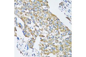 Immunohistochemistry of paraffin-embedded human lung cancer using SLC25A13 antibody. (slc25a13 antibody)