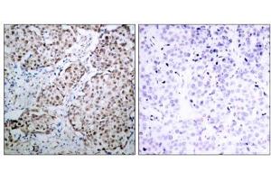 Immunohistochemical analysis of paraffin-embedded human breast carcinoma tissue using p53 (phospho- Ser315) antibody (E011100). (p53 antibody  (pSer315))