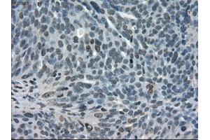 Immunohistochemical staining of paraffin-embedded Adenocarcinoma of breast tissue using anti-STAT1 mouse monoclonal antibody. (STAT1 antibody)